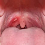 Even one drink a day may raise mouth cancer risk