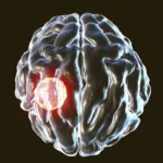 One in three people carry this brain parasite but the body has a kill switch