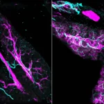 Scientists find nerves actively fuel pancreatic cancer