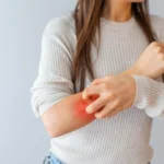 Scientists discover hidden sugar layer behind psoriasis