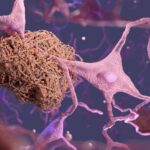 Scientists Discover Way To Reverse Chemical Process Linked With Alzheimer’s Disease